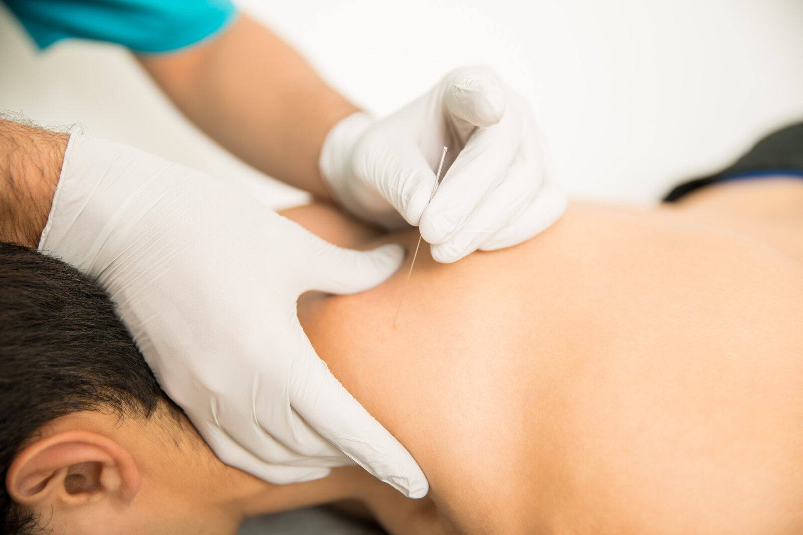 DryNeedling